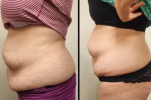 Before and After Photos for Cavi-Lipo Body Contouring treatments