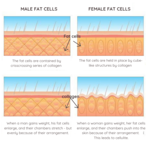 Female cellulite causes vs Male cellulite