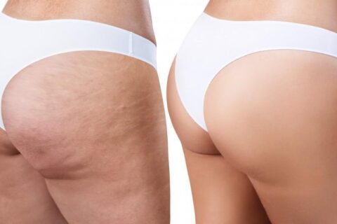 Cellulite found on the legs and buttocks can be treated at Laser Skin Solutions
