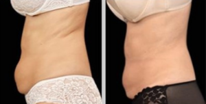 Coolsculpting to freeze fat away and avoid surgery for stomach fat and fat under the chin.