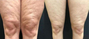 Tighten loose skin with skin tightening treatments and remedies for cellulite with Vela Shape cellulite treatment options. 