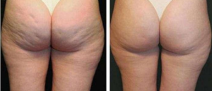 Even out skin textures with cellulite treatments to the back of the thighs and butt.