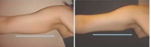 Arm Fat treatment with Skin tightening to the arms with Vela Shape