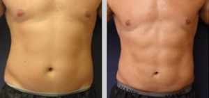 Avoid body fat surgery with body sculpting services to get rid of belly fat and tighten stomach skin.
